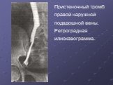 Пристеночный тромб правой наружной подвдошной вены. Ретроградная илиокавограмма.