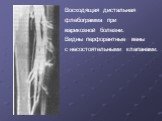 Восходящая дистальная флебограмма при варикозной болезни. Видны перфорантные вены с несостоятельными клапанами.
