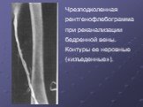 Чрезподколенная рентгенофлебограмма при реканализации бедренной вены. Контуры ее неровные («изъеденные»).