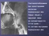 Рентгенофлебограмма при односторонней окклюзии подвздошных вен. Левые общая и наружная вены не контрастируются. Отток крови – по системе внутренних подвздошных вен.
