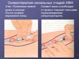 Склеротерапия начальных стадий ХВН. Этап. Появление темной крови в шприце После пункции варикозной вены. Сегмент вены освобожден от крови и пережат пальцами перед введением склеропрепарата.