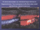 УЗ ангиосканограмма при клапанной недостаточности бедренной вены. При проведении пробы Вальсавы синий цветовой код сменяется красным.