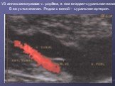 УЗ ангиосканограмма v. poplitea, в нее впадает суральная вена. В ее устье клапан. Рядом с веной – суральная артерия.