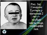 Рис. 3а). Синдром Гунтера у мальчика 2 лет — грубые черты лица, скафоцефалия.