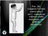 Рис. 3б). Синдром Гунтера у мальчика 2 лет — изменения скелета слабо выражены, нет кифоза, контрактур.