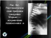 Рис. 6а). Рентгенологические признаки синдрома Моркио — искривление позвоночника и платиспондилия.