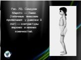 Рис. 7б). Синдром Марото — Лами: (типичные внешние проявления у девочки 9 лет) — контрактуры верхних и нижних конечностей.