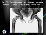 Рис. 8б). Рентгенологические признаки синдрома Марото — Лами — деформация костей таза.
