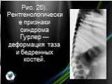 Рис. 2б). Рентгенологические признаки синдрома Гурлер — деформация таза и бедренных костей.