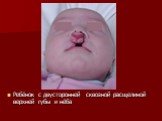 Ребёнок с двусторонней сквозной расщелиной верхней губы и нёба