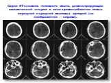 Серия КТ-снимков головного мозга, демонстрирующая ишемический инсульт в зоне кровоснабжения левых передней и средней мозговых артерий (на изображении — справа).
