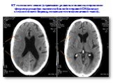 КТ головного мозга (стрелками указаны косвенные признаки формирующейся ишемии в бассейне правой СМА в виде сглаженности борозд, локального отека мозговой ткани).