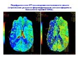 Перфузионное КТ-исследование головного мозга (стрелками указана формирующаяся зона инфаркта в бассейне правой СМА).