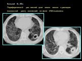 Больной В., 60л. Периферический рак нижней доли левого легкого с распадом («полостной рак»), возникший на фоне ИФАльвеолита.