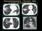 Бронхиолоальвеолярный ( or Alveolar cell carcinoma of lung)