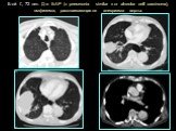 Б-oй Г., 72 лет. Д-з: БАР (« pneumonia similar » or alveolar cell carcinoma), эмфизема, расслаивающаяся аневризма аорты.