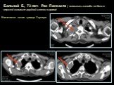 Больной Е., 73 лет. Рак Панкоста ( появились жалобы на боли в верхней половине грудной клетки справа). Клинически явная триада Горнера.