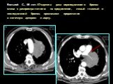 Больной С., 59 лет. КТ-картина рака верхнедолевого бронха слева с распространением на средостение, левый главный и нижнедолевой бронхи, признаками прорастания в легочную артерию и аорту.