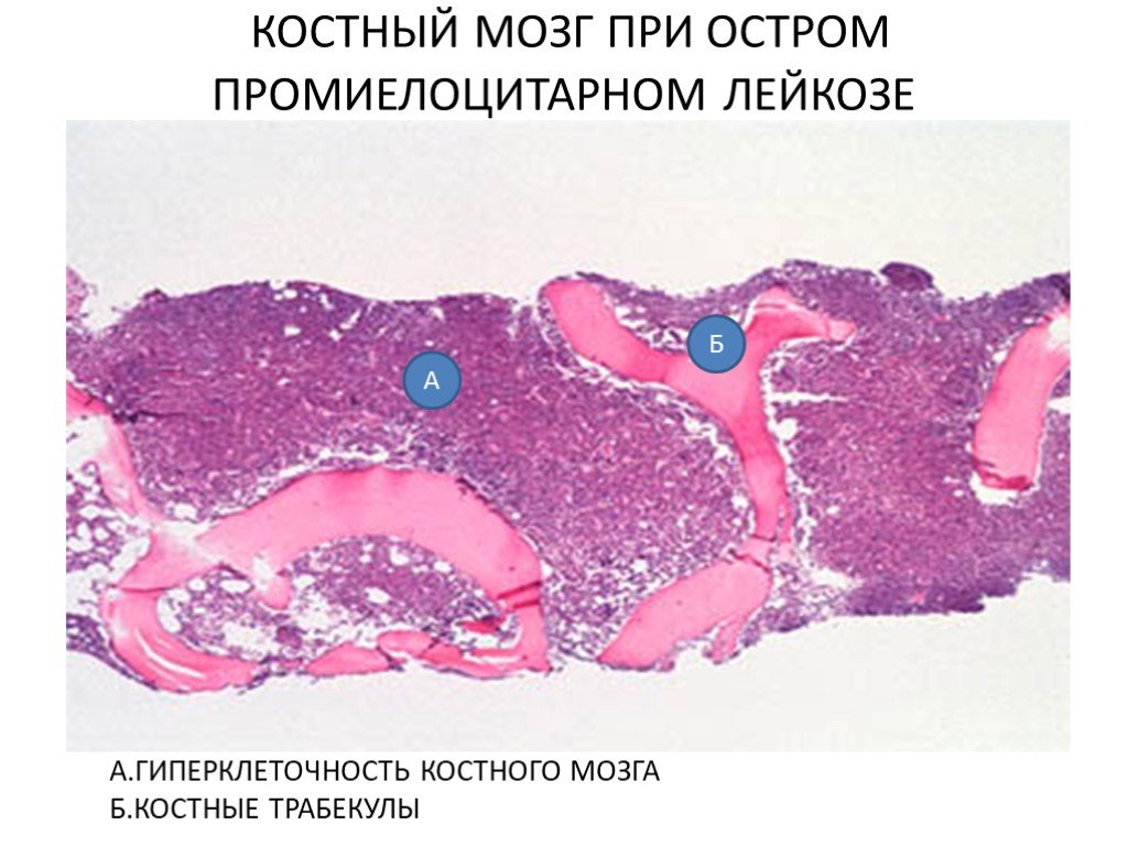 Мозг при остром лейкозе. Костный мозг при остром лейкозе. Костный мозг при остром миелолейкозе. Костный мозг при лейкозе микропрепарат. Костный мозг при лейкозе гистология.
