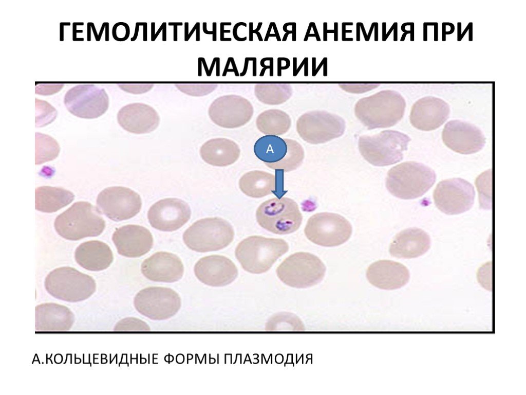 Несколько ведущих генераций плазмодиев в патогенезе малярии. Механизм развития анемии при малярии. Гемолитическая анемия мазок крови. Гемолитическая анемия при малярии. Патогенез анемии при малярии.