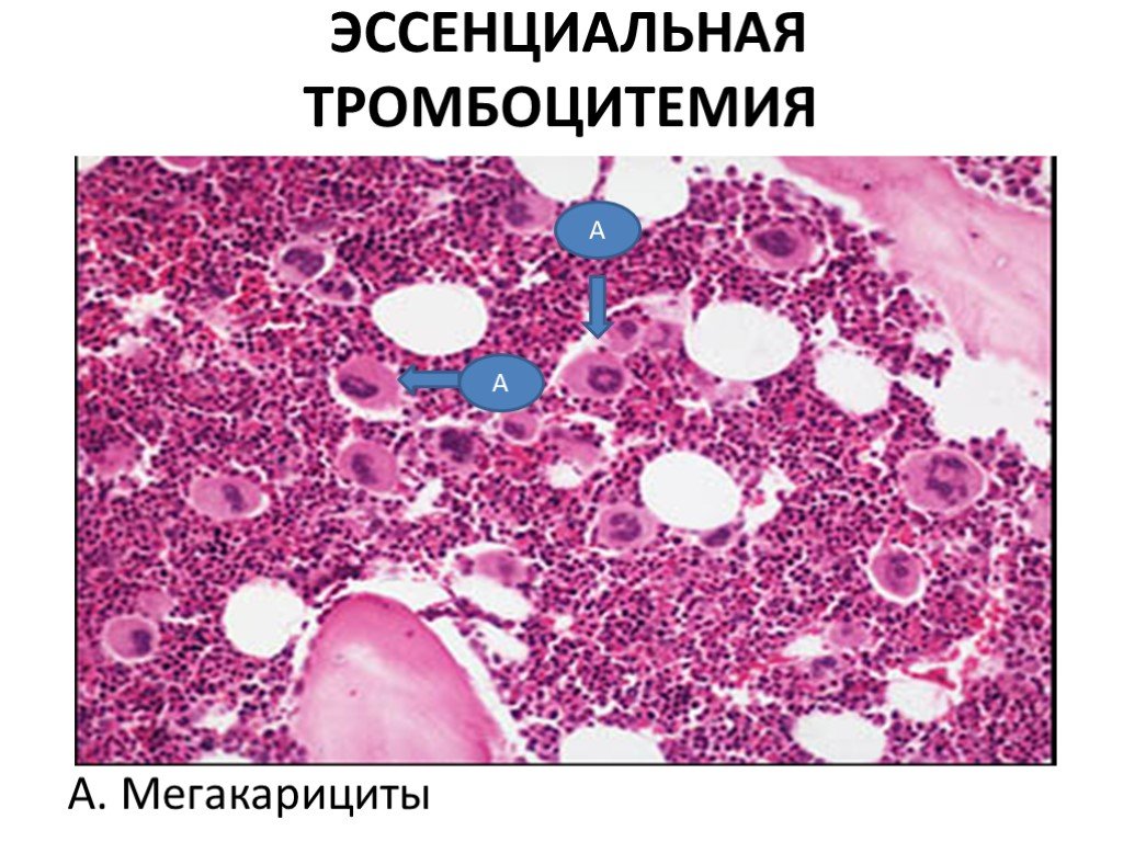 Эссенциальная тромбоцитопения. Эссенциальный тромбоцитоз. Картина крови при эссенциальной тромбоцитемии. Эссенциальный тромбоцитоз (эссенциальная тромбоцитемия).
