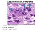 Ходжкинская лимфома. А.Клетки Рида-Штернберга Б.Малые лимфоциты В.Плазматические клетки