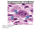 А.Клетки Рида-Штернберга Б.Малые лимфоциты В.Эозинофилы