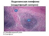 Ходжкинская лимфома (нодулярный склероз). А.Лимфоидный узел Б.Склероз
