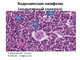 А.Лакунарные клетки Б.Малые лимфоциты