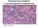Ходжкинская лимфома (с преобладанием лимфоцитов). А.Попкорн (L&H) клетки Б.Малые лимфоциты