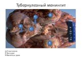 Туберкулезный менингит. А.Ствол мозга Б.Экссудат В.Височные доли