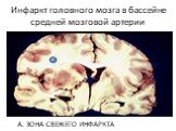 Инфаркт головного мозга в бассейне средней мозговой артерии. А. ЗОНА СВЕЖЕГО ИНФАРКТА