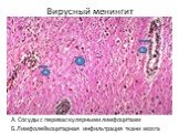 Вирусный менингит. А. Сосуды с периваскулярными лимфоцитами Б.Лимфолейкоцитарная инфильтрация ткани мозга