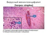 Вирусный менингоэнцефалит (herpes simplex). А.Периваскулярный лимфоцитарный инфильтрат Б.Микроглиальный узел с некрозом