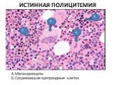 ИСТИННАЯ ПОЛИЦИТЕМИЯ. А.Мегакариоциты Б.Созревающие эритроидные клетки