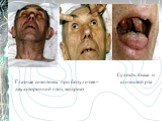 Глазные симптомы при ботулизме – двухсторонний птоз, мидриаз. Сухость языка и слизистой рта
