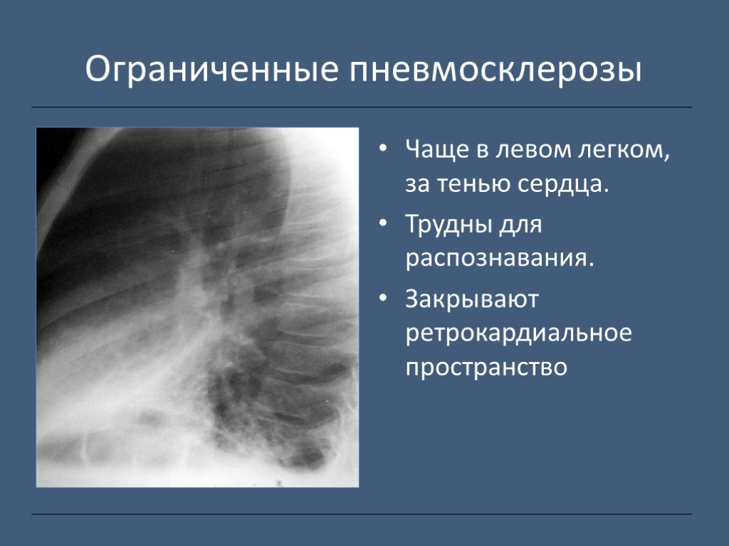 Пневмосклероз это простыми словами. Очаговый пневмосклероз. Пневмосклероз рентген. Ограниченный пневмосклероз легких что это.
