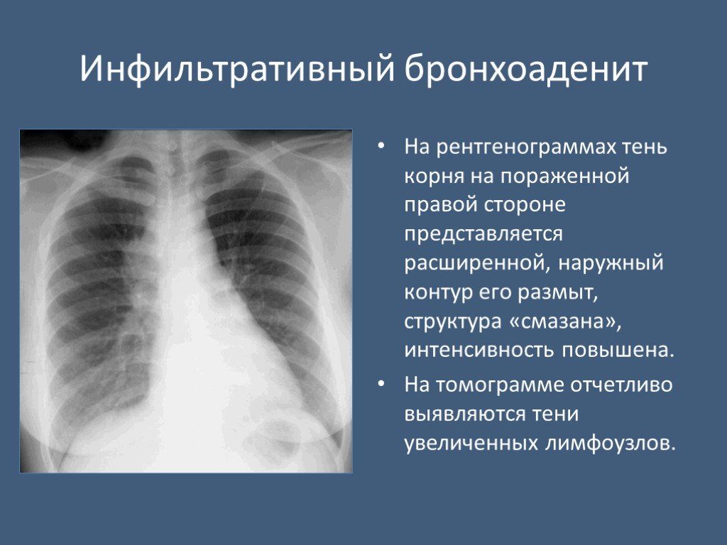 Без очаговых и инфильтративных изменений. Расширение корня легкого на рентгенограмме. Инфильтративный туберкулёз лёгких рентген. Инфильтративный туберкулез рентгенограмма. Инфильтративный туберкулез синдромы рентген.