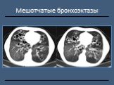 Рентгендиагностика бронхолёгочной патологии Слайд: 17