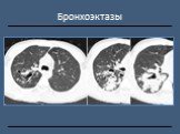 Рентгендиагностика бронхолёгочной патологии Слайд: 19