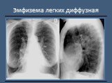 Рентгендиагностика бронхолёгочной патологии Слайд: 22