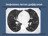 Рентгендиагностика бронхолёгочной патологии Слайд: 23