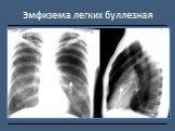 Рентгендиагностика бронхолёгочной патологии Слайд: 26