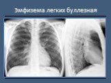 Рентгендиагностика бронхолёгочной патологии Слайд: 27
