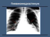 Рентгендиагностика бронхолёгочной патологии Слайд: 48