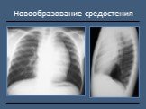 Рентгендиагностика бронхолёгочной патологии Слайд: 51