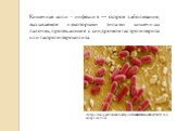 Кишечная коли - инфекция — острое заболевание, вызываемое некоторыми типами кишечных палочек, протекающее с синдромом гастроэнтерита или гастроэнтероколита. Энтерогеморрагическая бактерия Escherichia coli (EHEC) под микроскопом