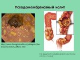 http://www.health.am/ab/more/early-intervention-by-infectious-diseases/. http://www.sharinginhealth.ca/pathogens/bacteria/clostridium_difficile.html