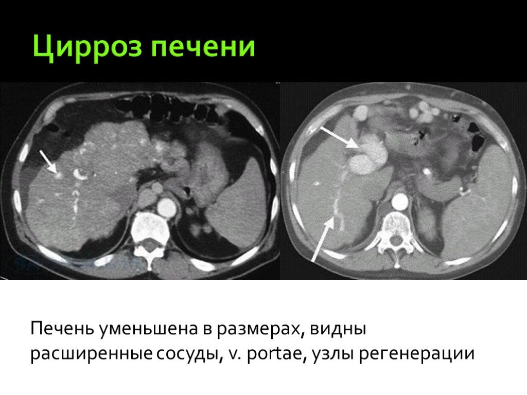 Сосудистый рисунок печени ослаблен