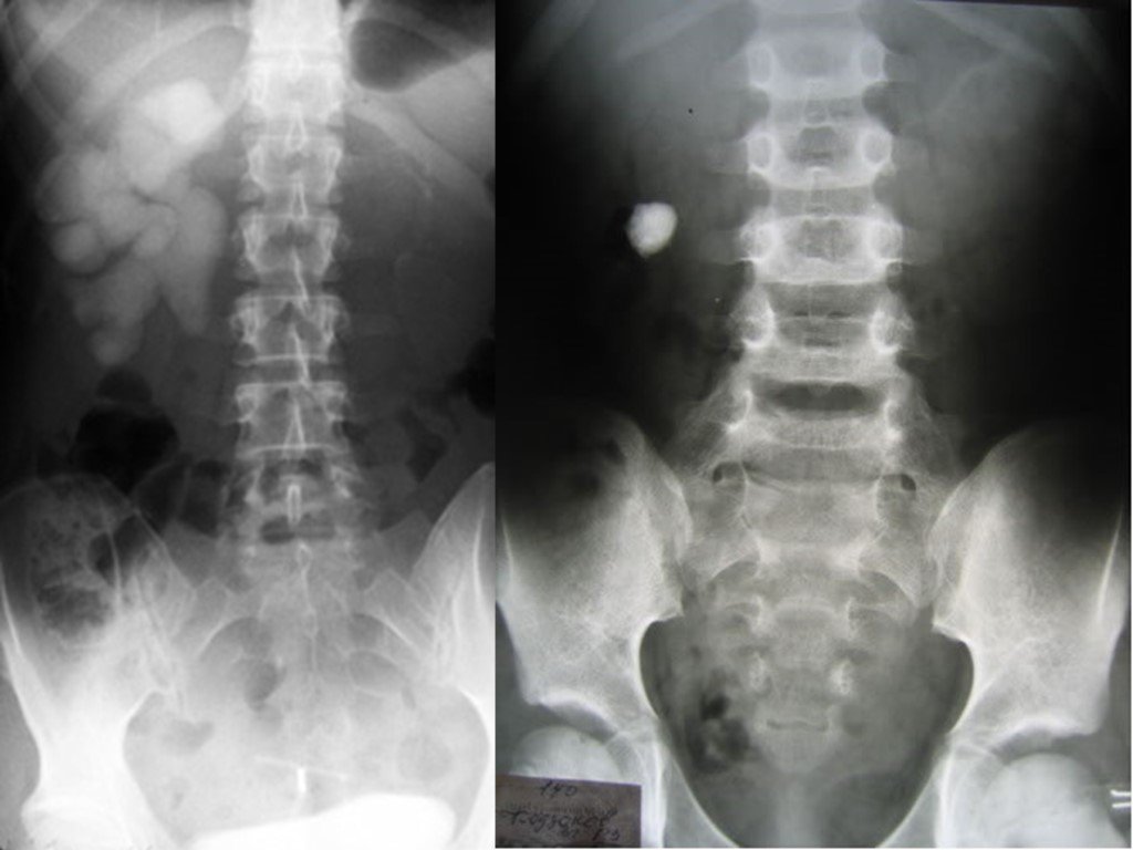Рентген почек. Обзорная урограмма мочекаменная болезнь. Обзорная рентгенография урография. Обзорная рентгенография почек урография. Обзорная урограмма почек.